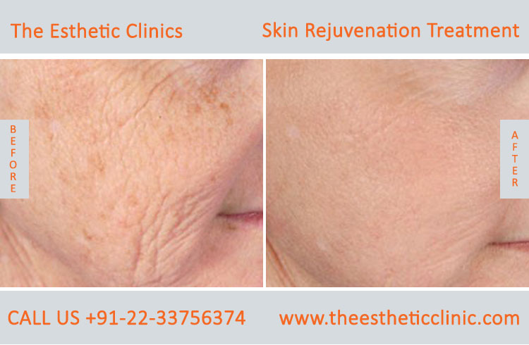 Skin Rejuvenation whitening lightening Laser Treatment before after photos in mumbai india